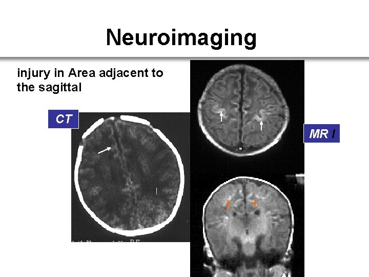 Neuroimaging injury in Area adjacent to the sagittal CT MR I 