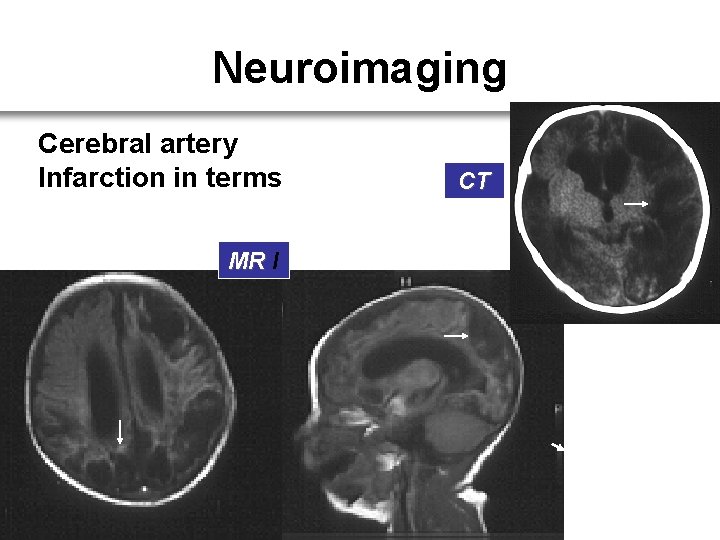 Neuroimaging Cerebral artery Infarction in terms MR I CT 