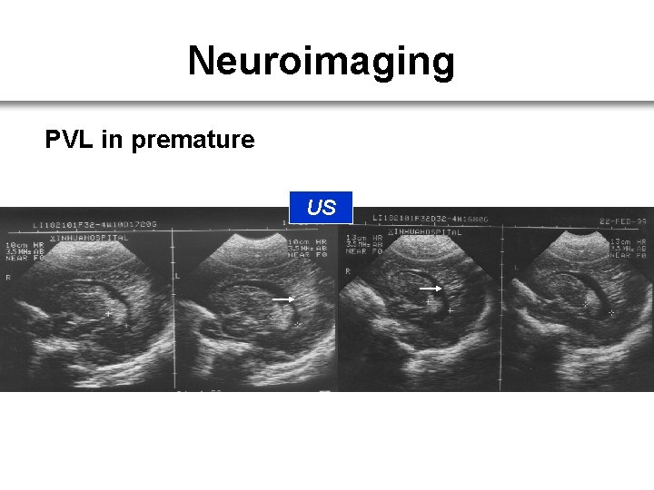 Neuroimaging PVL in premature US 