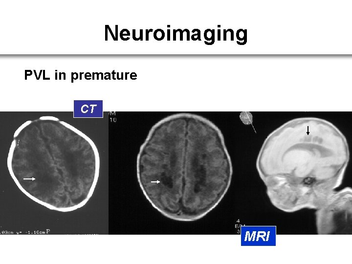 Neuroimaging PVL in premature CT MRI 