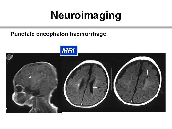 Neuroimaging Punctate encephalon haemorrhage MRI 