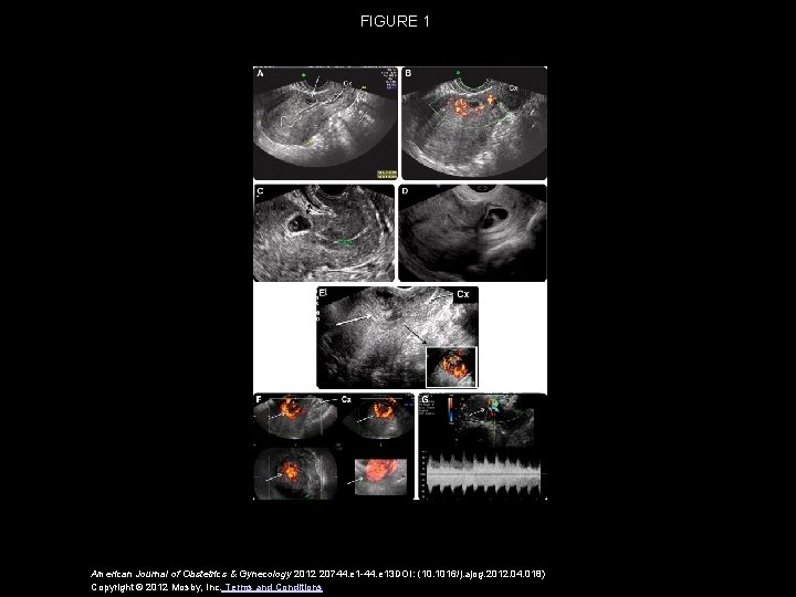 FIGURE 1 American Journal of Obstetrics & Gynecology 2012 20744. e 1 -44. e