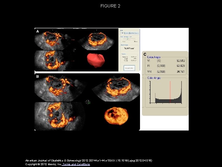 FIGURE 2 American Journal of Obstetrics & Gynecology 2012 20744. e 1 -44. e