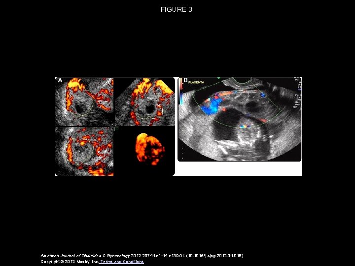 FIGURE 3 American Journal of Obstetrics & Gynecology 2012 20744. e 1 -44. e