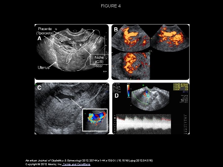 FIGURE 4 American Journal of Obstetrics & Gynecology 2012 20744. e 1 -44. e