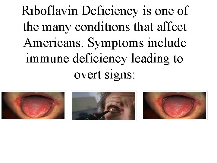 Riboflavin Deficiency is one of the many conditions that affect Americans. Symptoms include immune