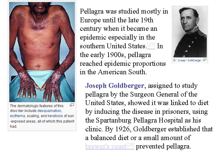 Pellagra was studied mostly in Europe until the late 19 th century when it