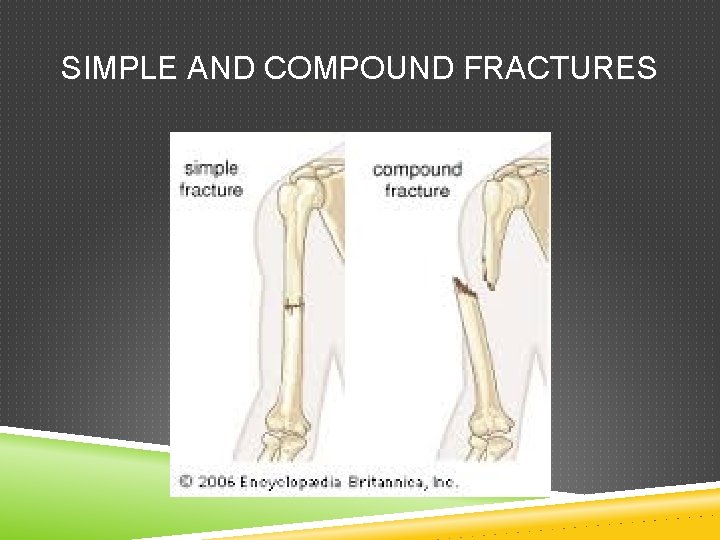 SIMPLE AND COMPOUND FRACTURES 