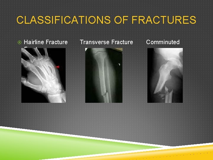 CLASSIFICATIONS OF FRACTURES Hairline Fracture Transverse Fracture Comminuted 