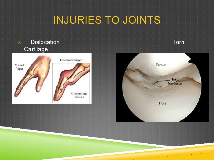 INJURIES TO JOINTS Dislocation Cartilage Torn 