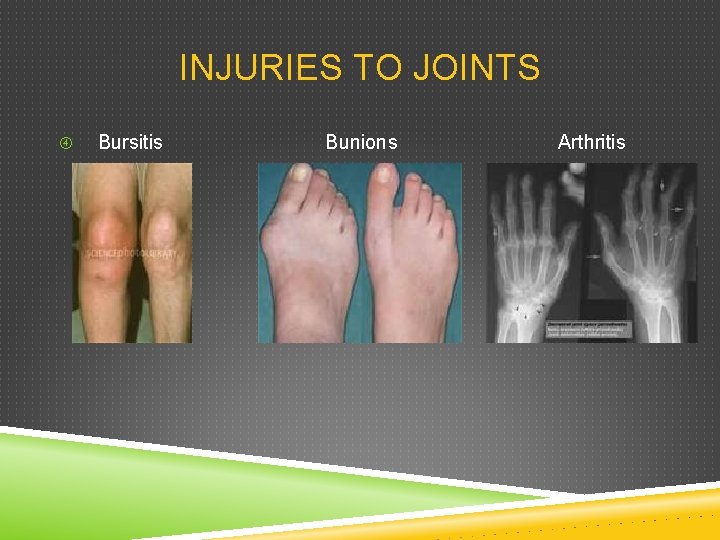 INJURIES TO JOINTS Bursitis Bunions Arthritis 