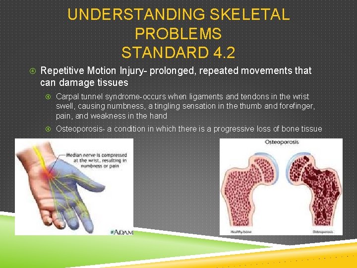 UNDERSTANDING SKELETAL PROBLEMS STANDARD 4. 2 Repetitive Motion Injury- prolonged, repeated movements that can