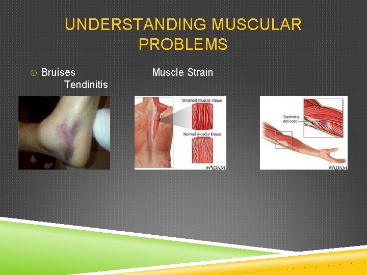 UNDERSTANDING MUSCULAR PROBLEMS Bruises Tendinitis Muscle Strain 