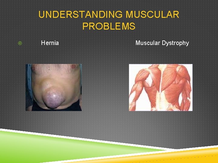 UNDERSTANDING MUSCULAR PROBLEMS Hernia Muscular Dystrophy 