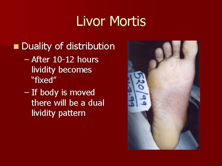 Livor Mortis n Duality of distribution – After 10 -12 hours lividity becomes “fixed”