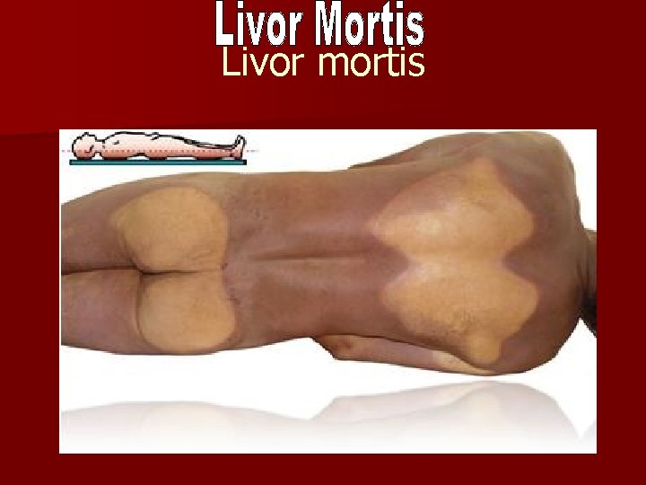 Livor mortis 