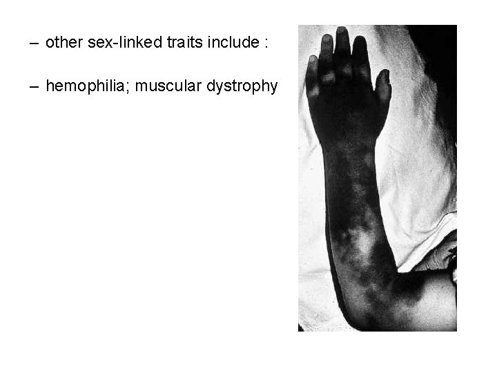 – other sex-linked traits include : – hemophilia; muscular dystrophy 