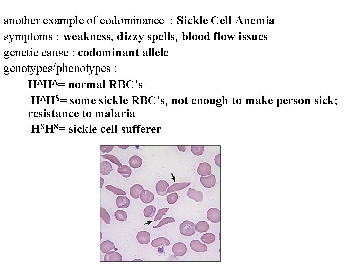 another example of codominance : Sickle Cell Anemia symptoms : weakness, dizzy spells, blood