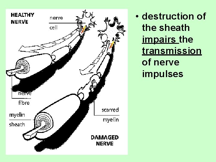  • destruction of the sheath impairs the transmission of nerve impulses 