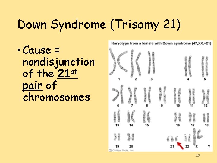 Down Syndrome (Trisomy 21) • Cause = nondisjunction of the 21 st pair of