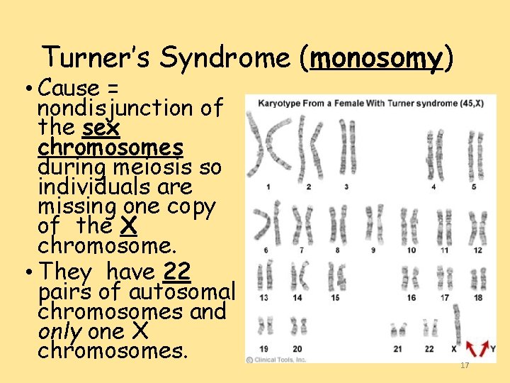 Turner’s Syndrome (monosomy) • Cause = nondisjunction of the sex chromosomes during meiosis so