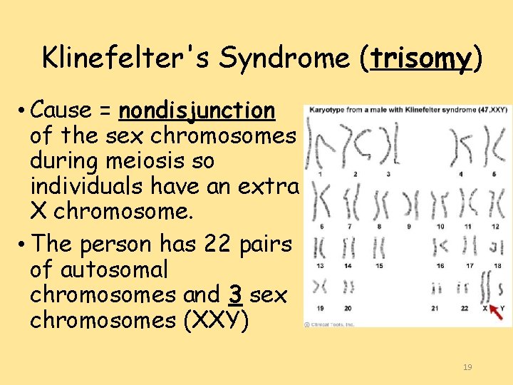 Klinefelter's Syndrome (trisomy) • Cause = nondisjunction of the sex chromosomes during meiosis so