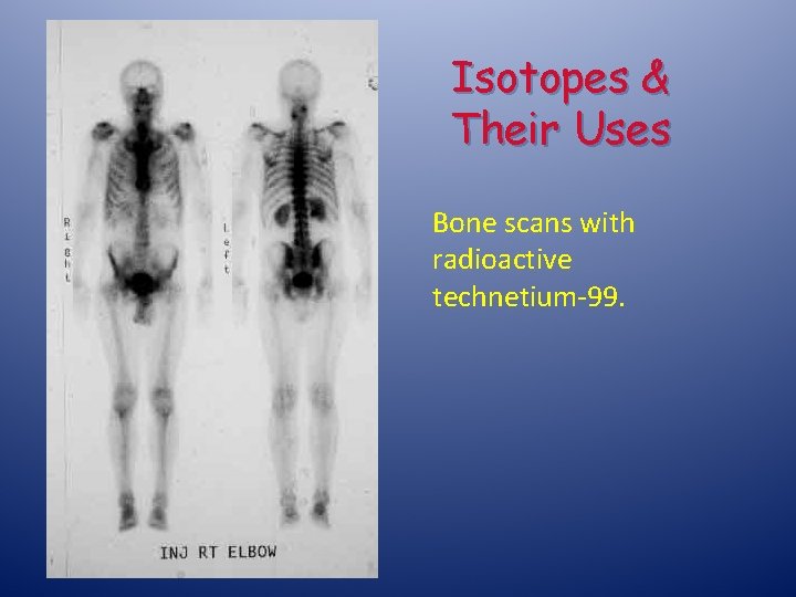 Isotopes & Their Uses Bone scans with radioactive technetium-99. 