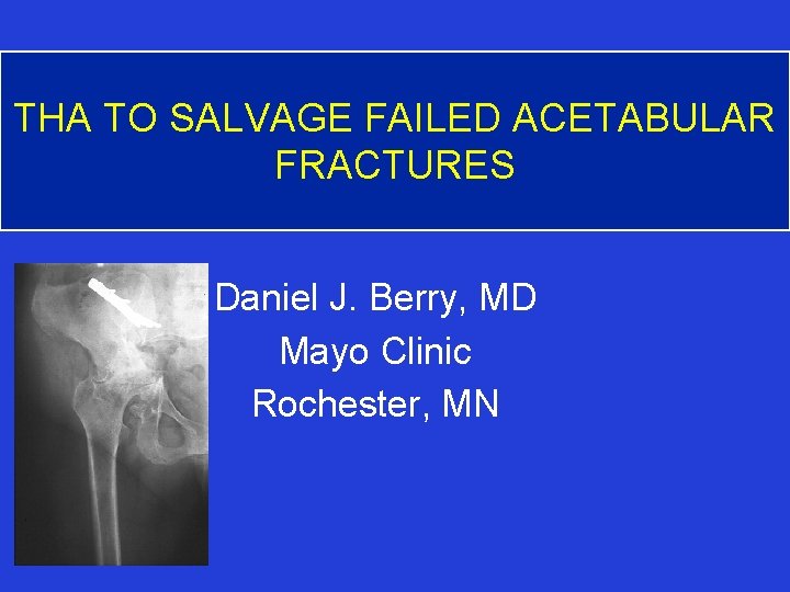 THA TO SALVAGE FAILED ACETABULAR FRACTURES Daniel J. Berry, MD Mayo Clinic Rochester, MN