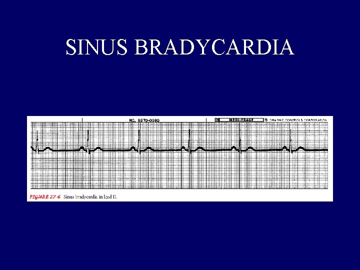 SINUS BRADYCARDIA 