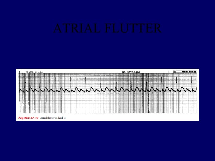ATRIAL FLUTTER 