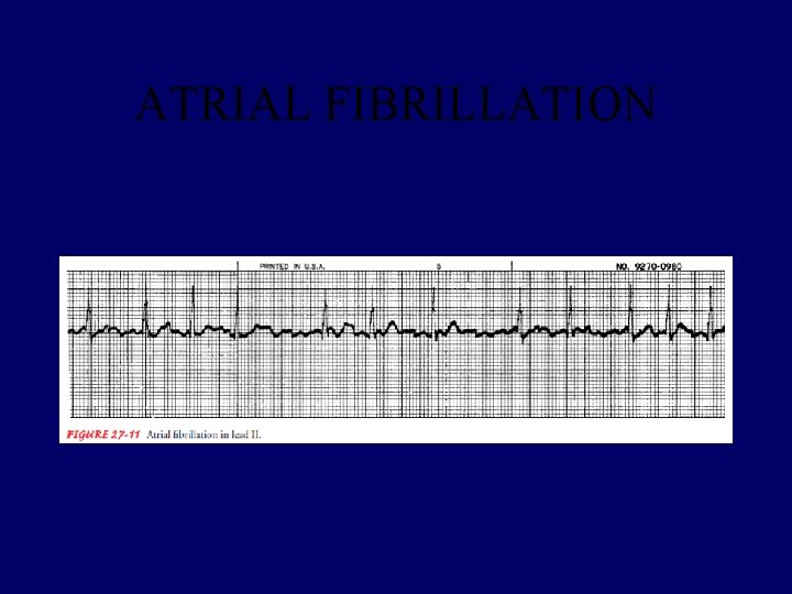 ATRIAL FIBRILLATION 