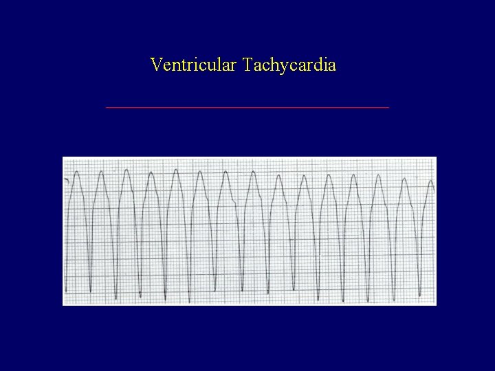 Ventricular Tachycardia 