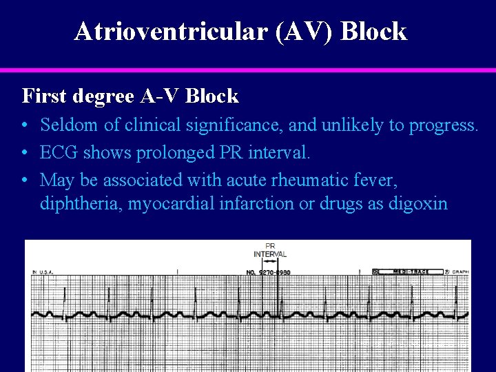 Atrioventricular (AV) Block First degree A-V Block • Seldom of clinical significance, and unlikely