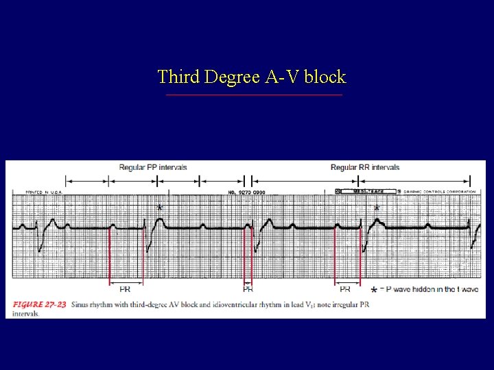 Third Degree A-V block 