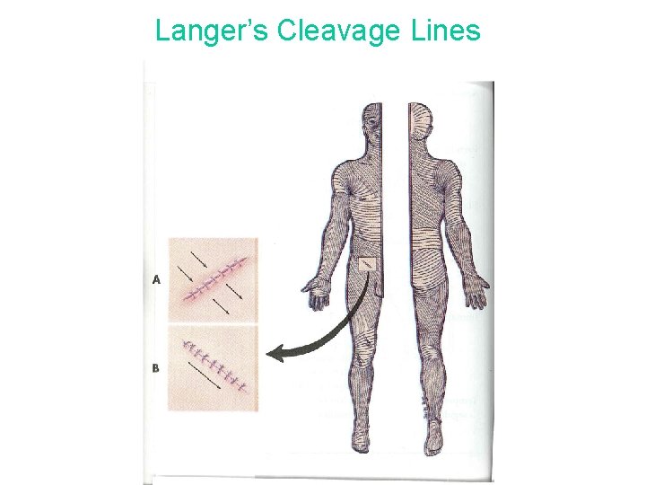 Langer’s Cleavage Lines 