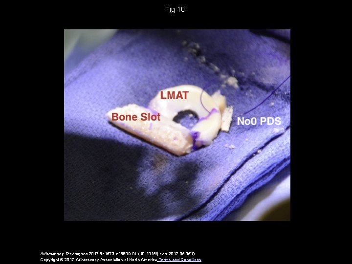 Fig 10 Arthroscopy Techniques 2017 6 e 1573 -e 1580 DOI: (10. 1016/j. eats.