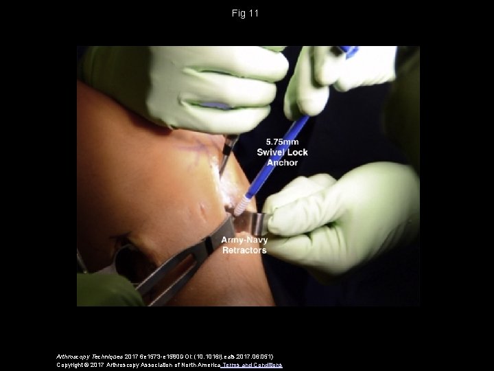 Fig 11 Arthroscopy Techniques 2017 6 e 1573 -e 1580 DOI: (10. 1016/j. eats.