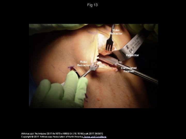 Fig 13 Arthroscopy Techniques 2017 6 e 1573 -e 1580 DOI: (10. 1016/j. eats.