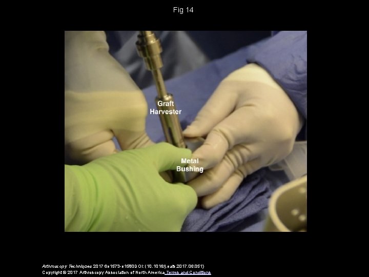 Fig 14 Arthroscopy Techniques 2017 6 e 1573 -e 1580 DOI: (10. 1016/j. eats.