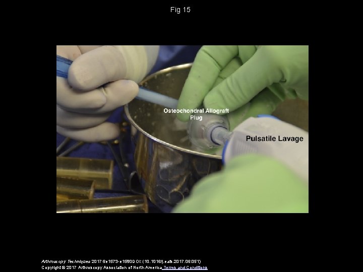 Fig 15 Arthroscopy Techniques 2017 6 e 1573 -e 1580 DOI: (10. 1016/j. eats.