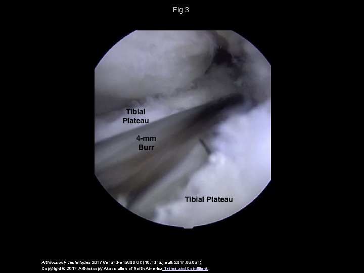 Fig 3 Arthroscopy Techniques 2017 6 e 1573 -e 1580 DOI: (10. 1016/j. eats.