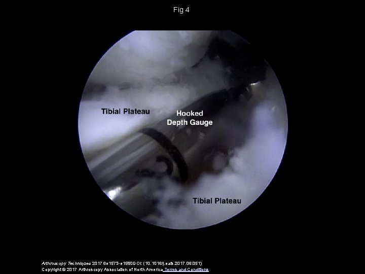 Fig 4 Arthroscopy Techniques 2017 6 e 1573 -e 1580 DOI: (10. 1016/j. eats.