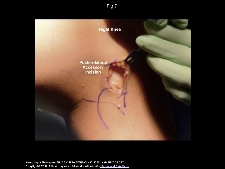 Fig 7 Arthroscopy Techniques 2017 6 e 1573 -e 1580 DOI: (10. 1016/j. eats.