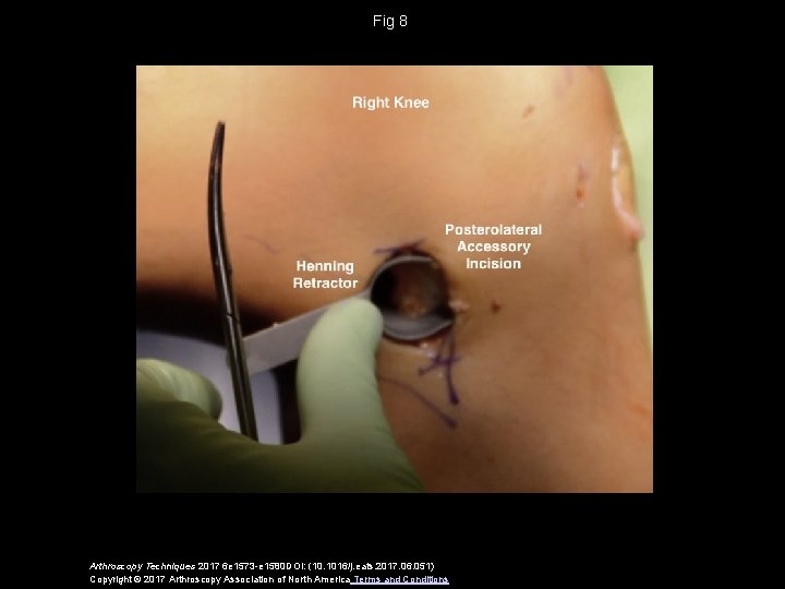 Fig 8 Arthroscopy Techniques 2017 6 e 1573 -e 1580 DOI: (10. 1016/j. eats.