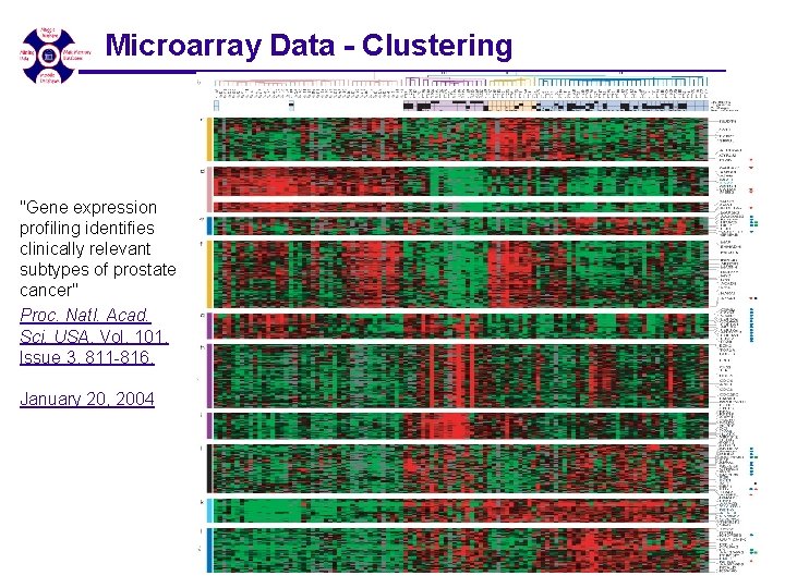 Microarray Data - Clustering "Gene expression profiling identifies clinically relevant subtypes of prostate cancer" Microarray Data - Clustering "Gene expression profiling identifies clinically relevant subtypes of prostate cancer"
