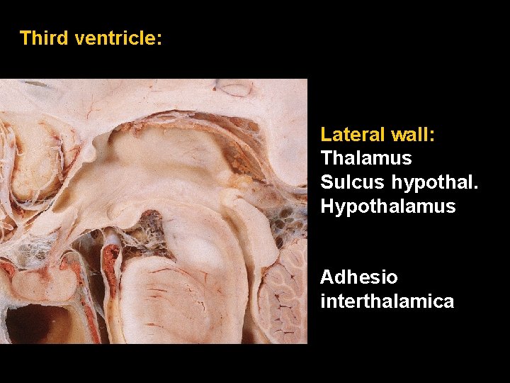 Third ventricle: Lateral wall: Thalamus Sulcus hypothal. Hypothalamus Adhesio interthalamica 