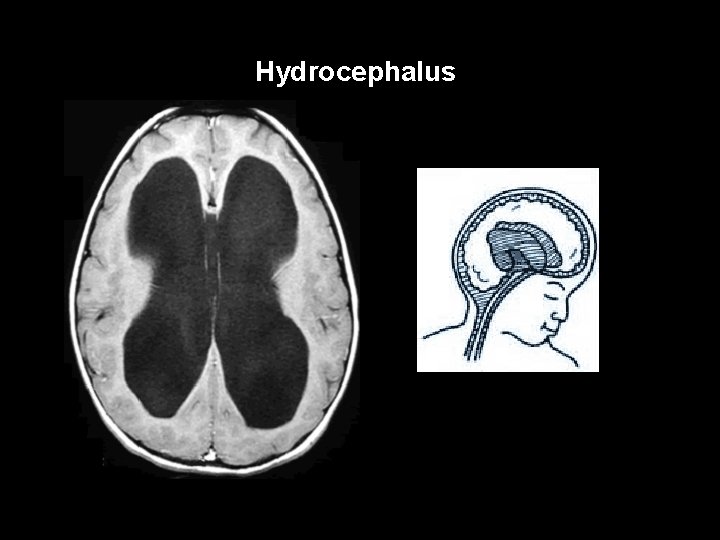 Hydrocephalus 