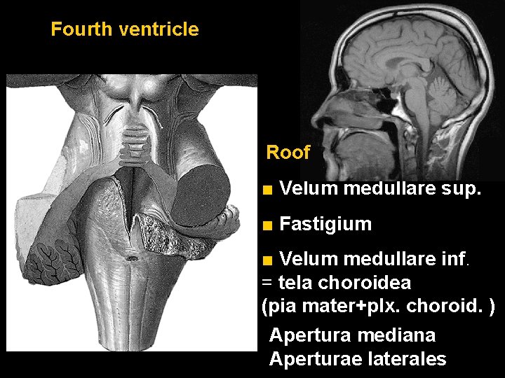 Fourth ventricle Roof ■ Velum medullare sup. ■ Fastigium ■ Velum medullare inf. =