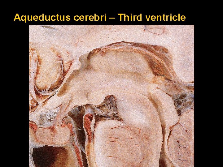 Aqueductus cerebri – Third ventricle 