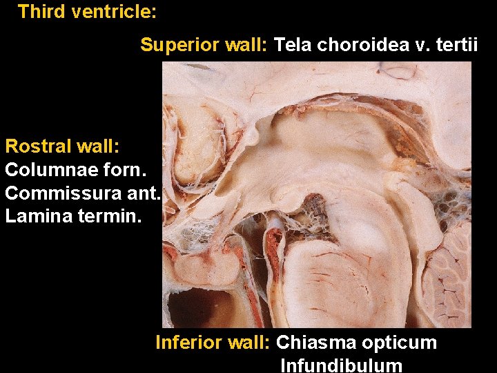 Third ventricle: Superior wall: Tela choroidea v. tertii Rostral wall: Columnae forn. Commissura ant.